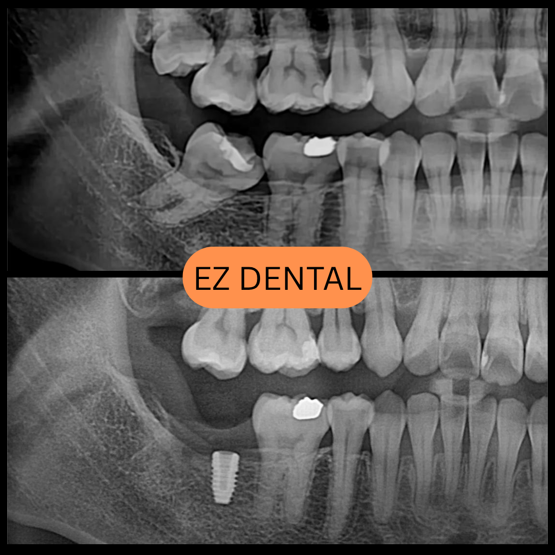 Dental Implant