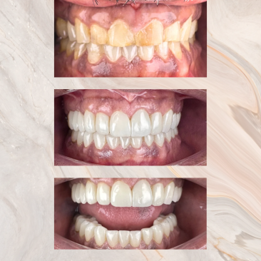 full mouth rehabilitation / smile makeover