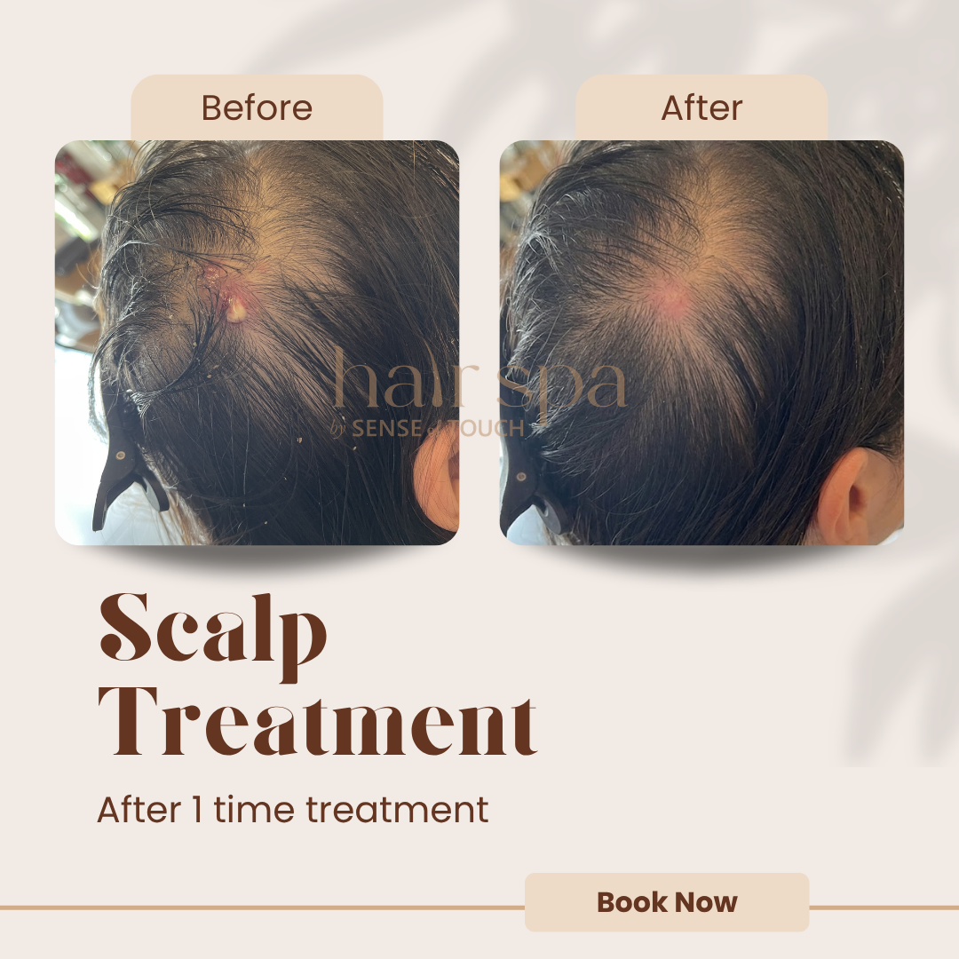 Sensitive / Acne / Inflammation Scalp Treatment
