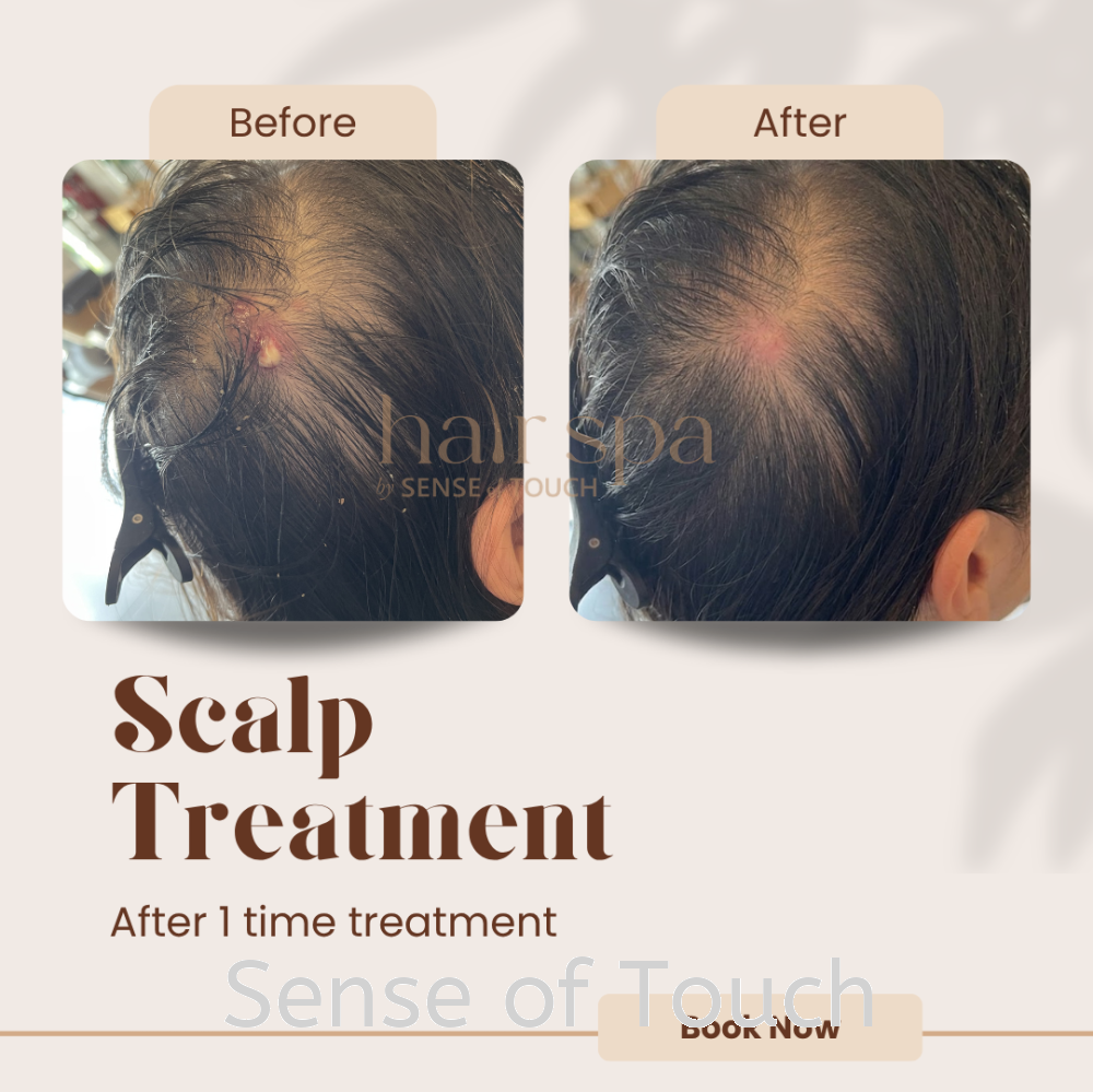 Sensitive / Acne / Inflammation Scalp Treatment
