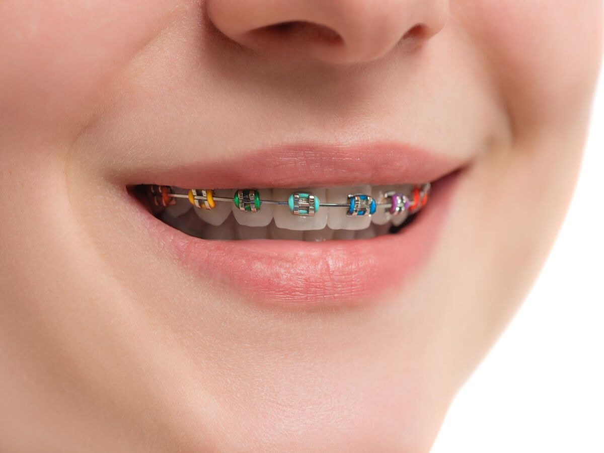 Conventional / Manual Braces