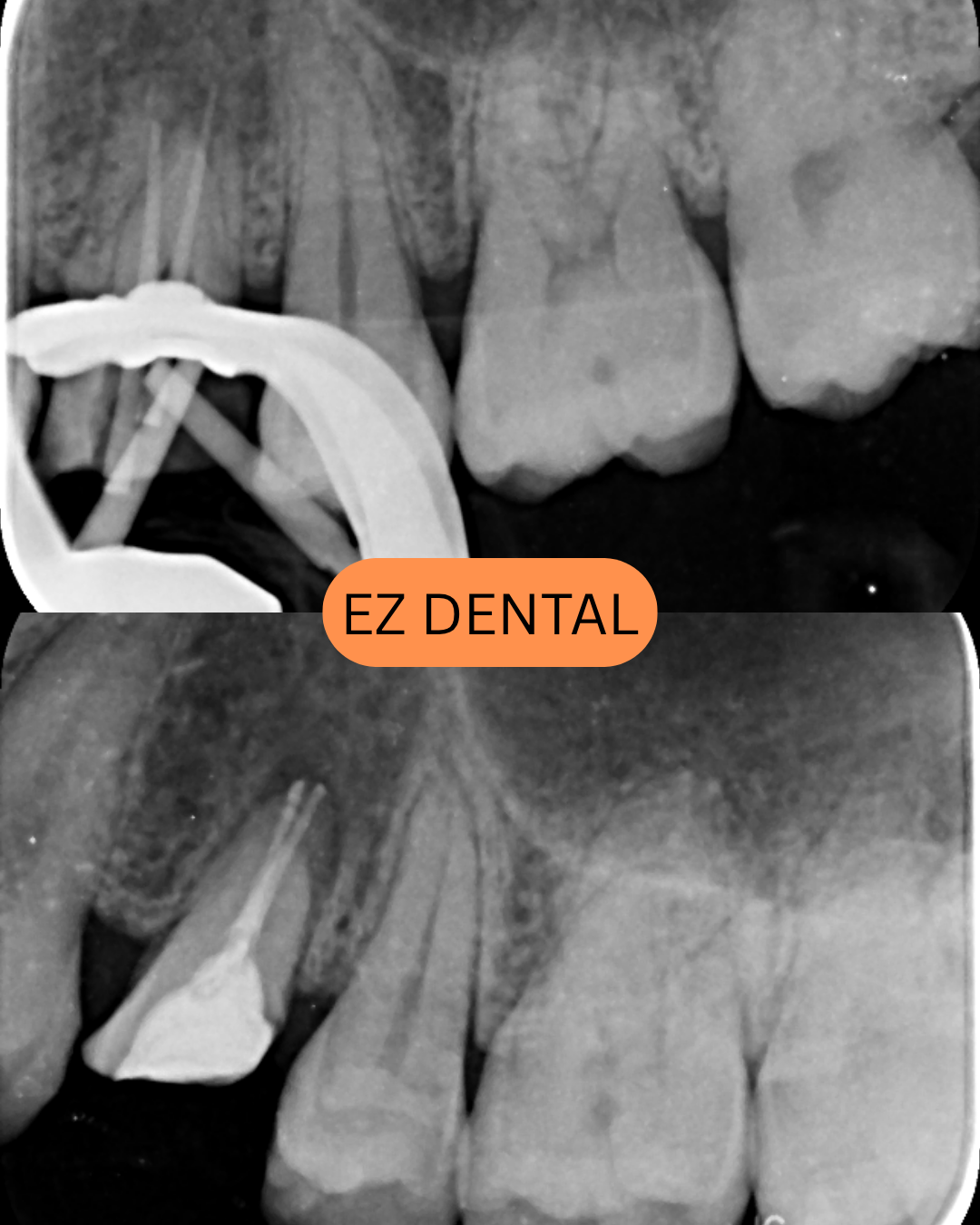 Root Canal Treatment
