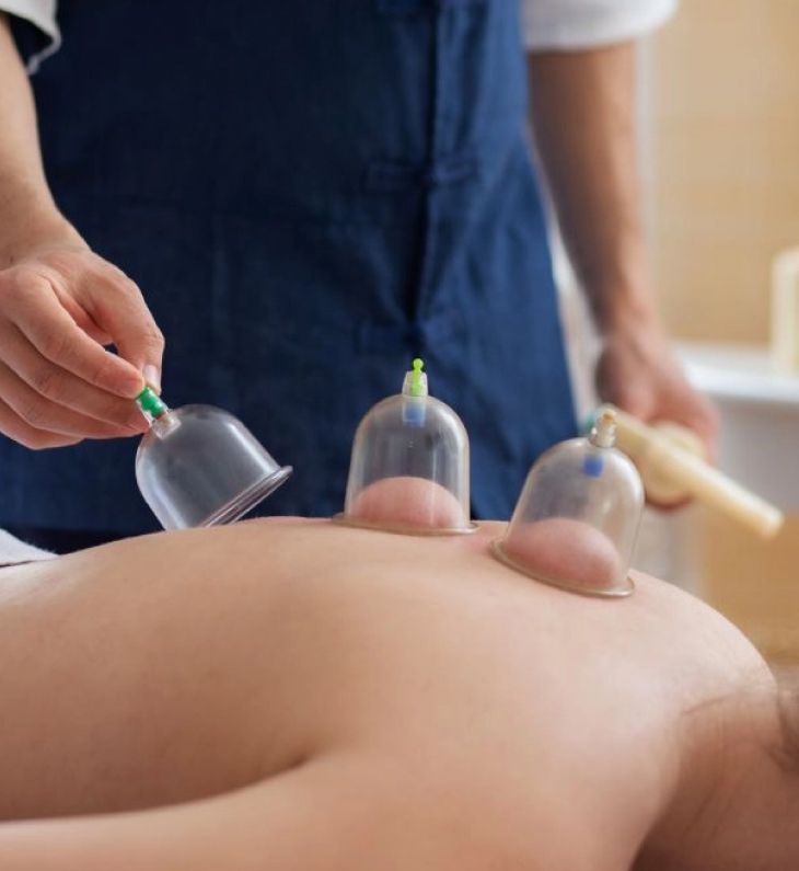 Cupping therapy