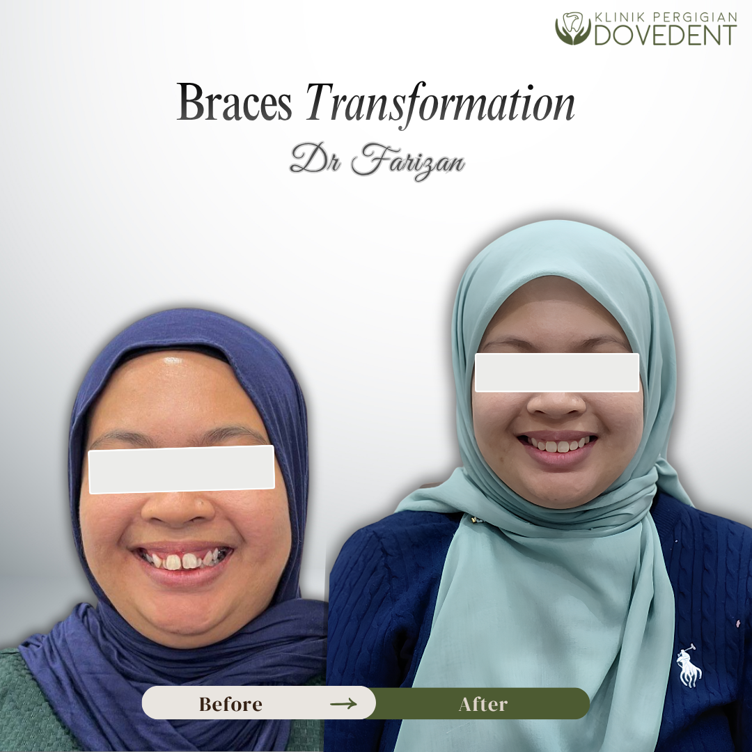 Smile Transformation