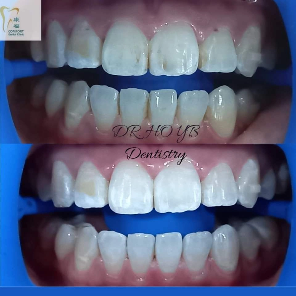 WHITENING