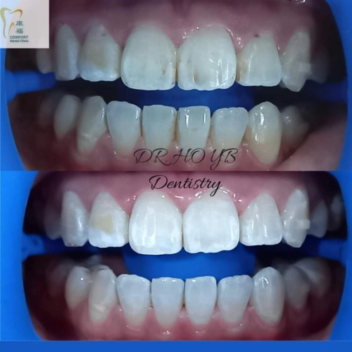 Teeth Whitening Treatment