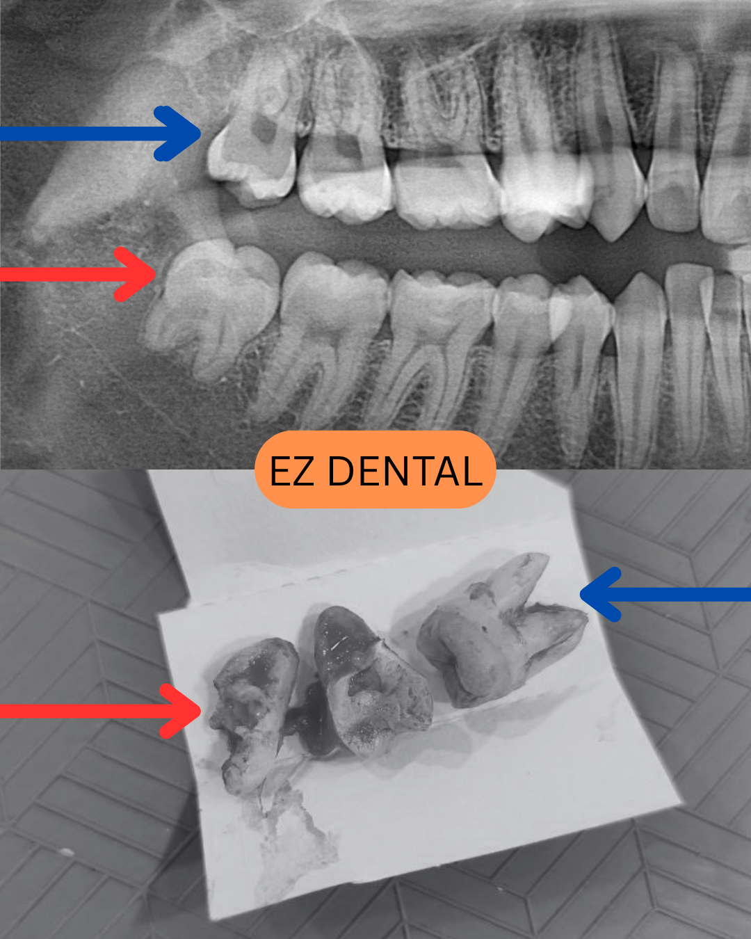 Wisdom Tooth Surgery