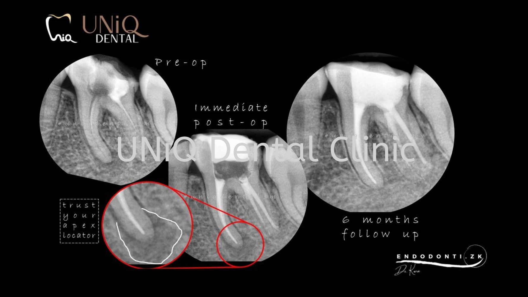 Root Canal Treatment