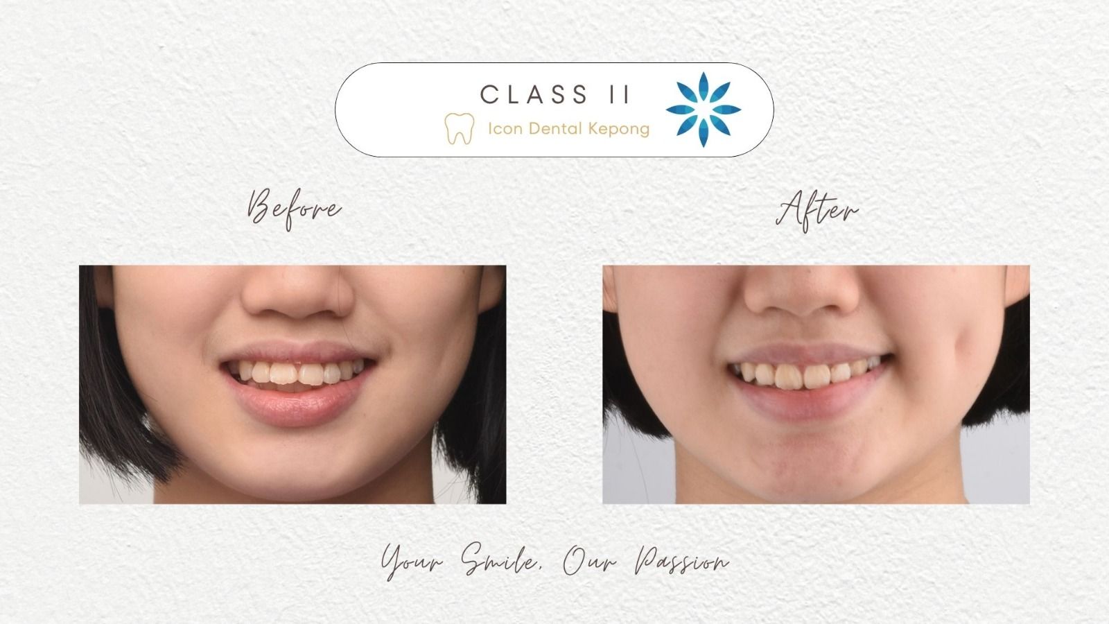 Invisalign