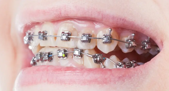 Self Ligating Braces (Metal)