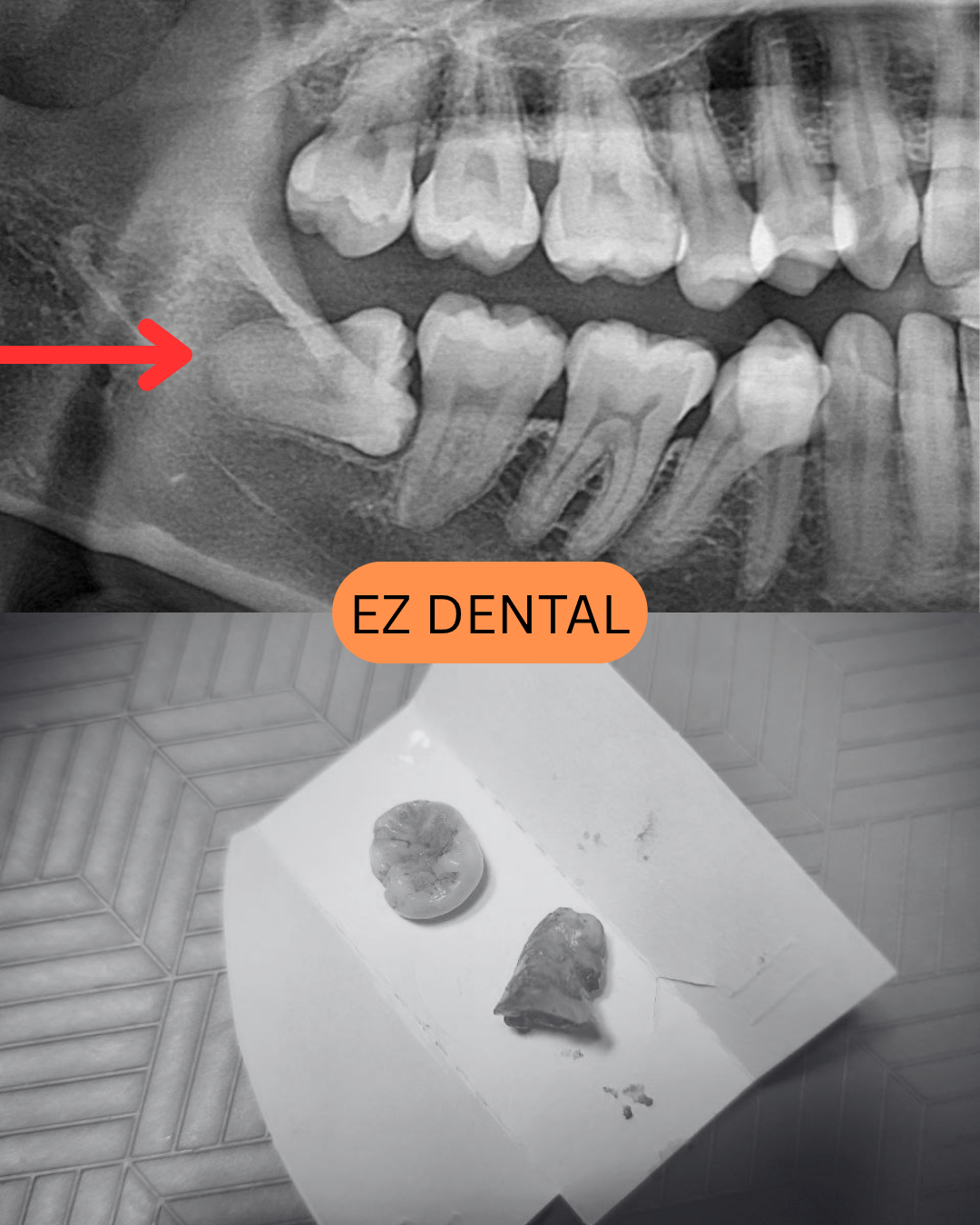 Wisdom Tooth Surgery Olive Hill