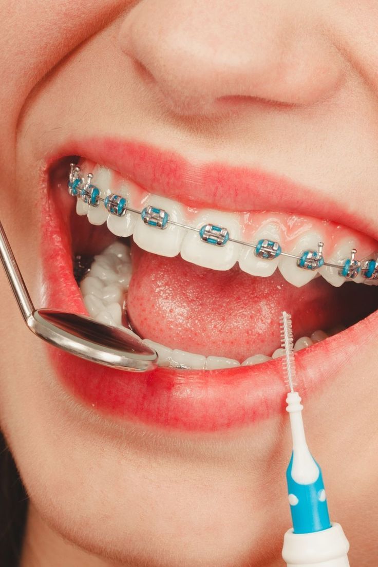 Affordable Braces Johor Bahru
