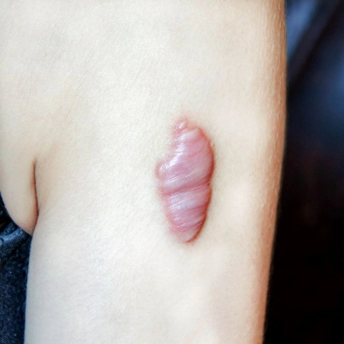 Keloid Removal