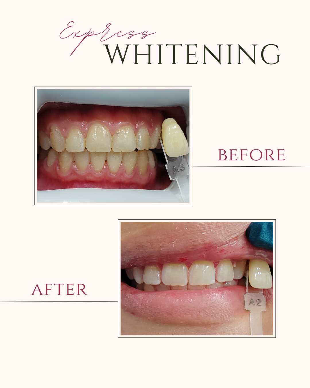 EXPRESS WHITENING