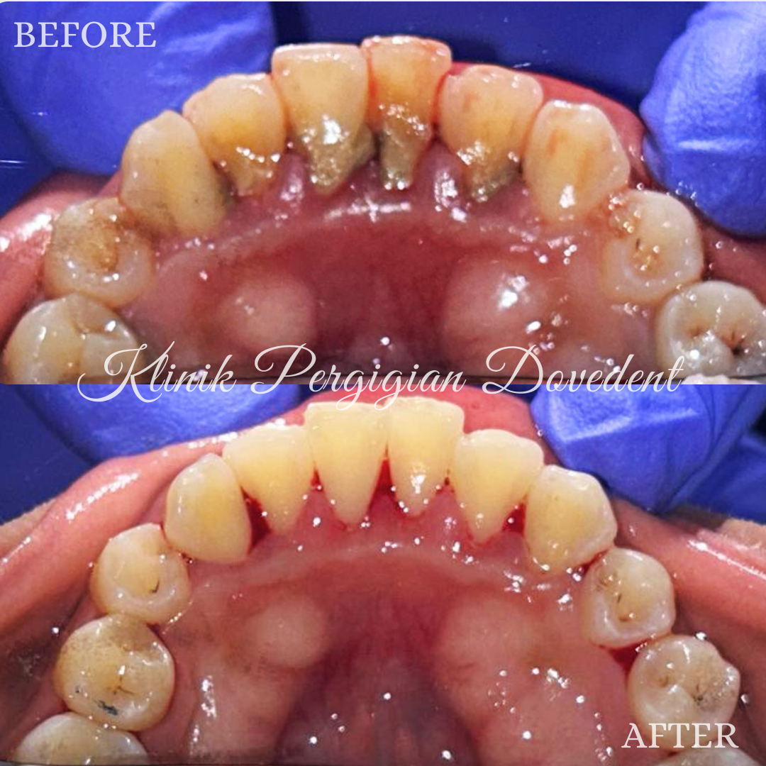 Scaling & Polishing Treatment