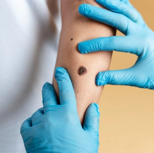 Mole Assessment