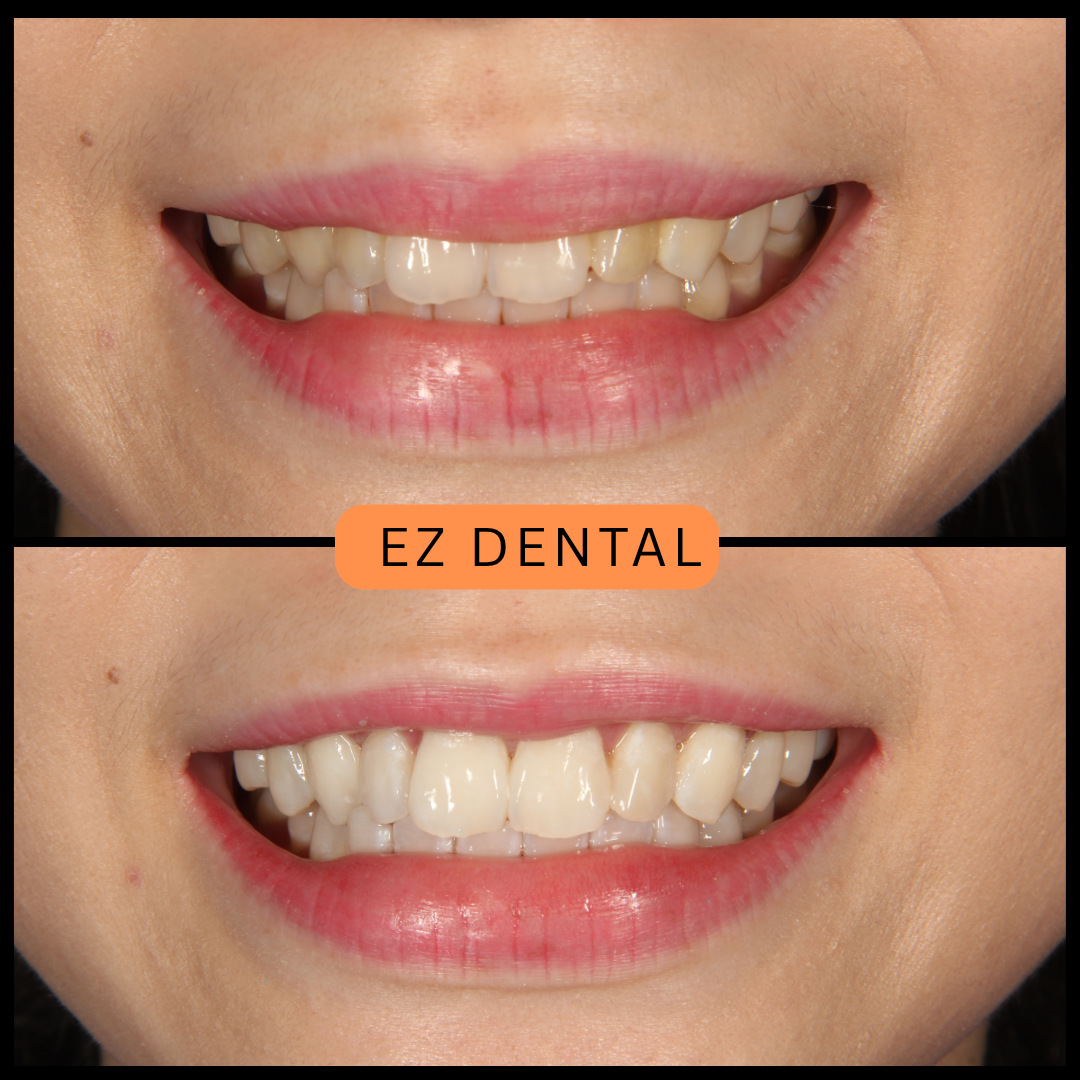 Teeth Whitening