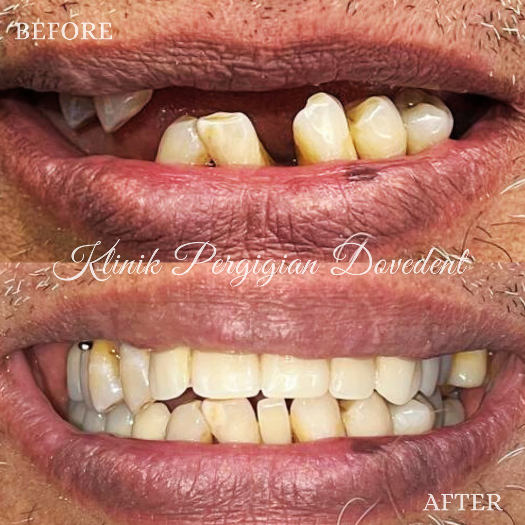 Removable Denture