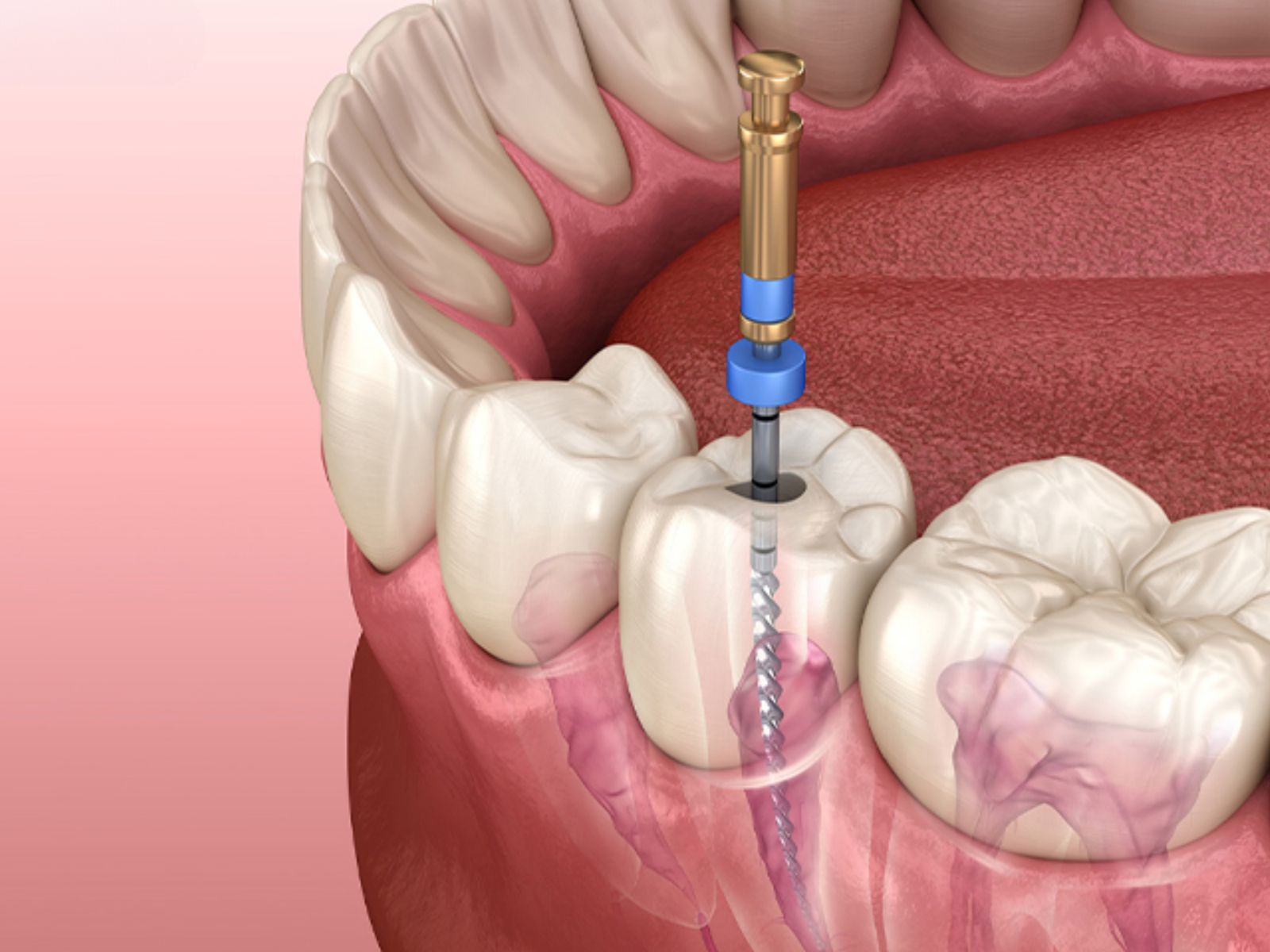 Root Canal Treatment