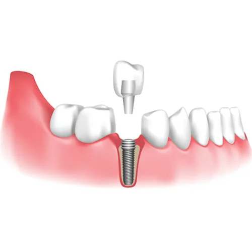 Dental Implant