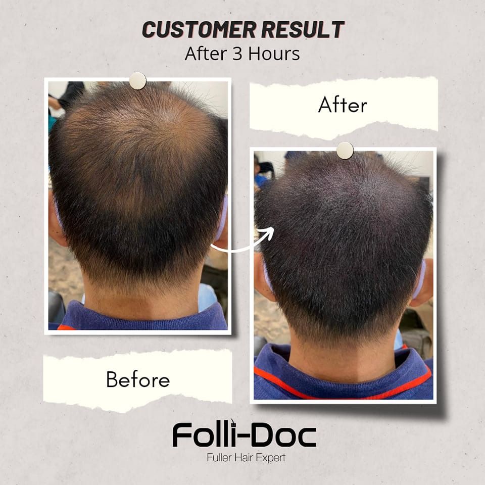 Hair Follicle Service