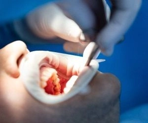 牙周手术