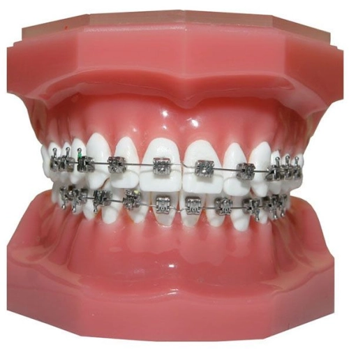 Conventional Braces (Metal)