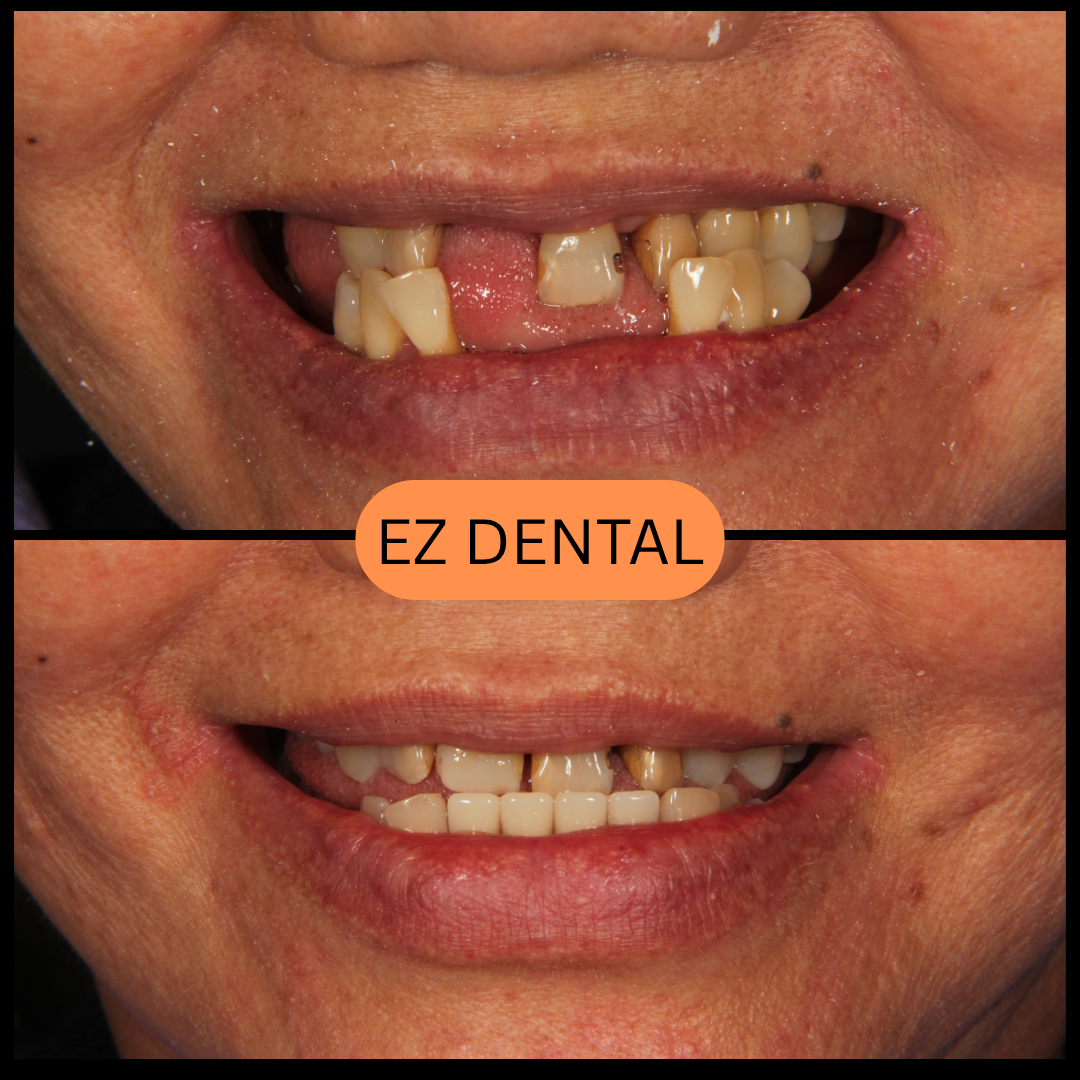 Denture