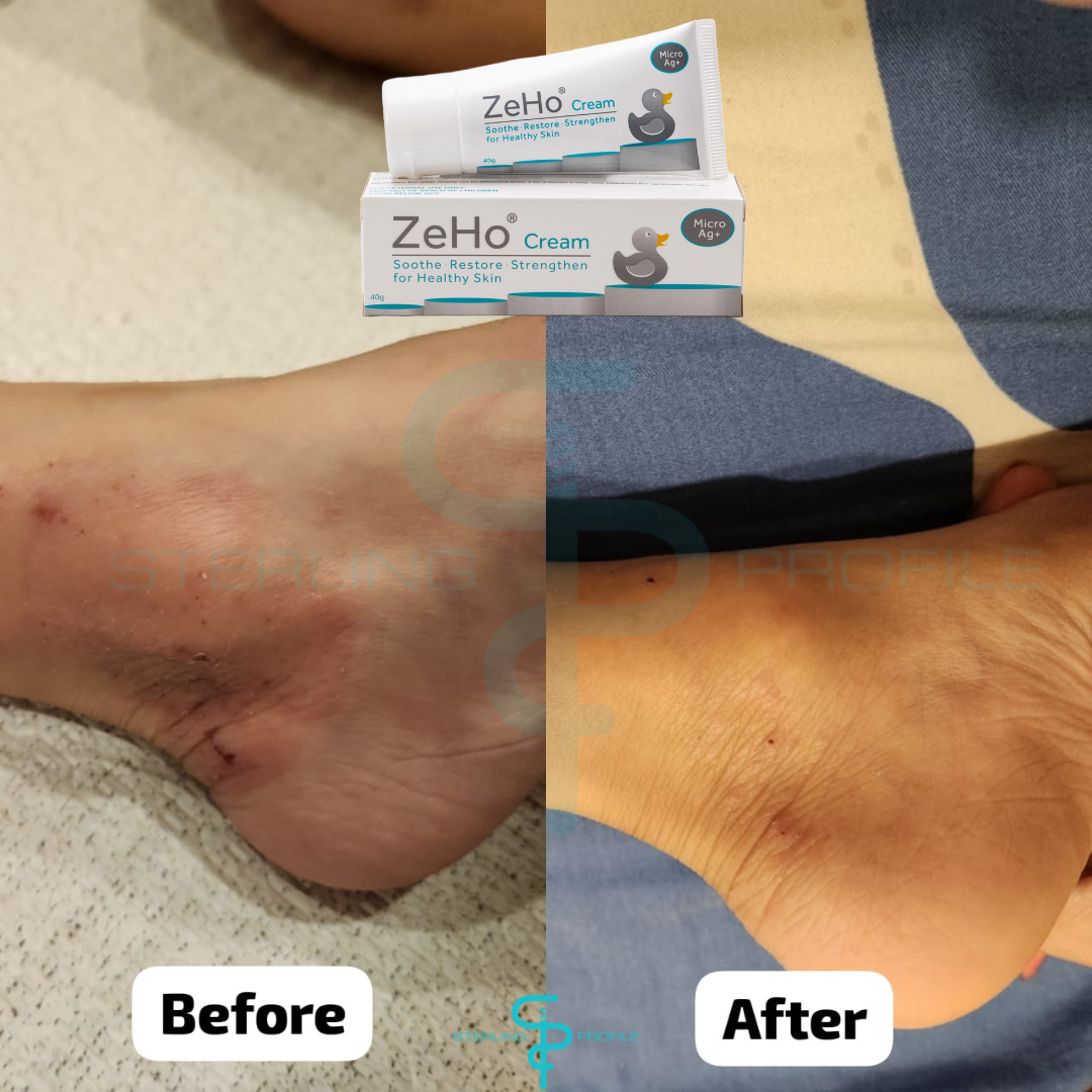 ZeHo MicroAg+ Cream Testimonial  & Sterling Profile Sdn Bhd