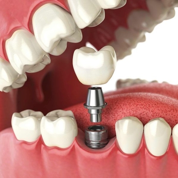 Dental Implant