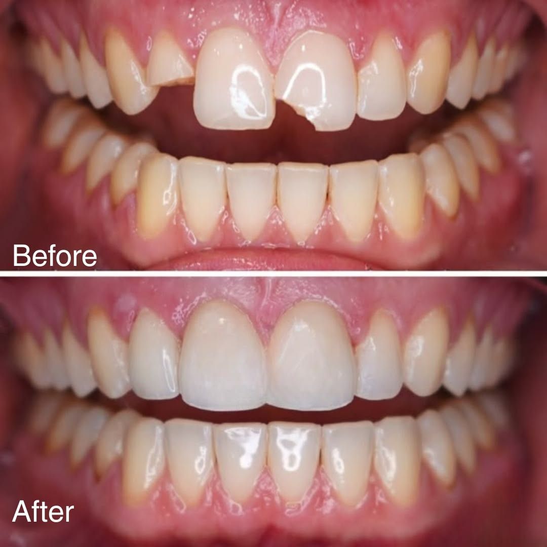 Tooth Filling Johor Bahru | Cavity Treatment JB Mount Austin & Taman Pelangi