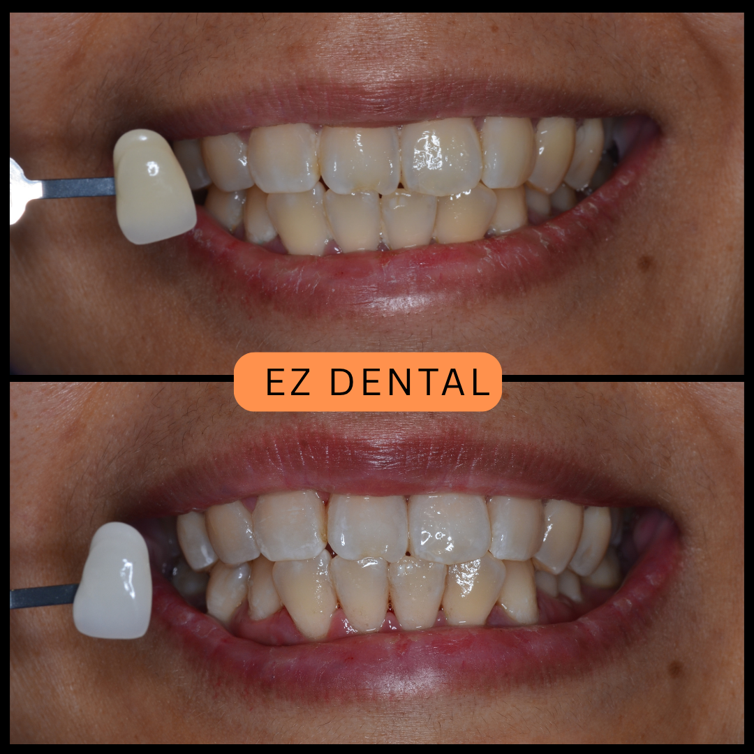 Teeth Whitening