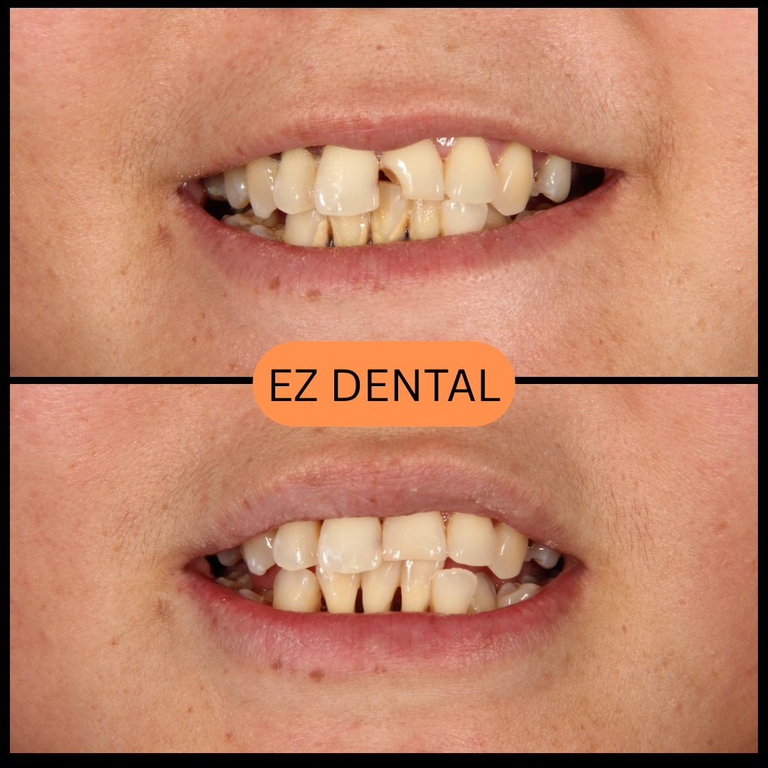 Composite Fillings
