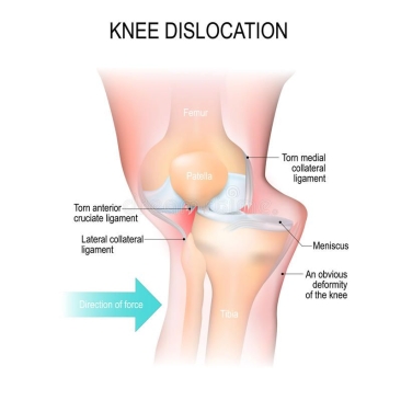 膝盖脱臼