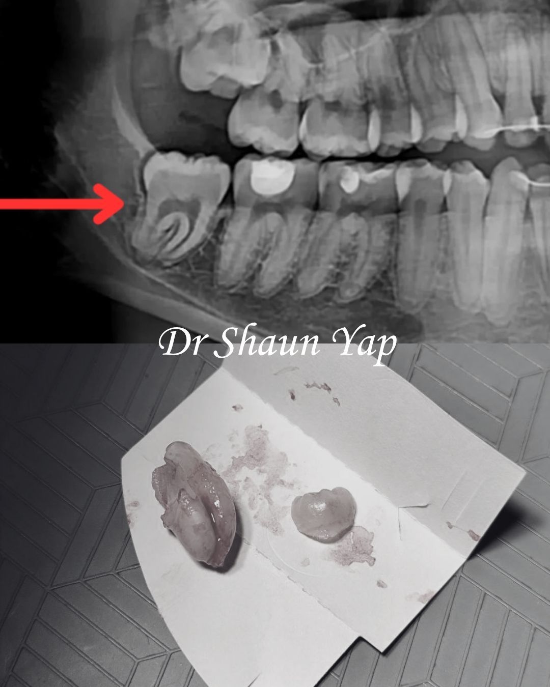 Wisdom Tooth Surgery