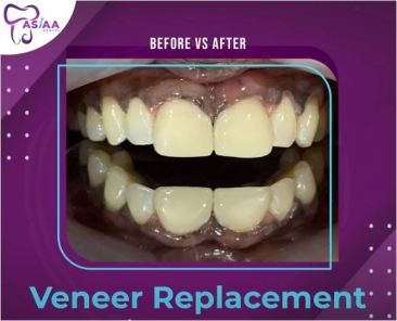 Veneers Treatment