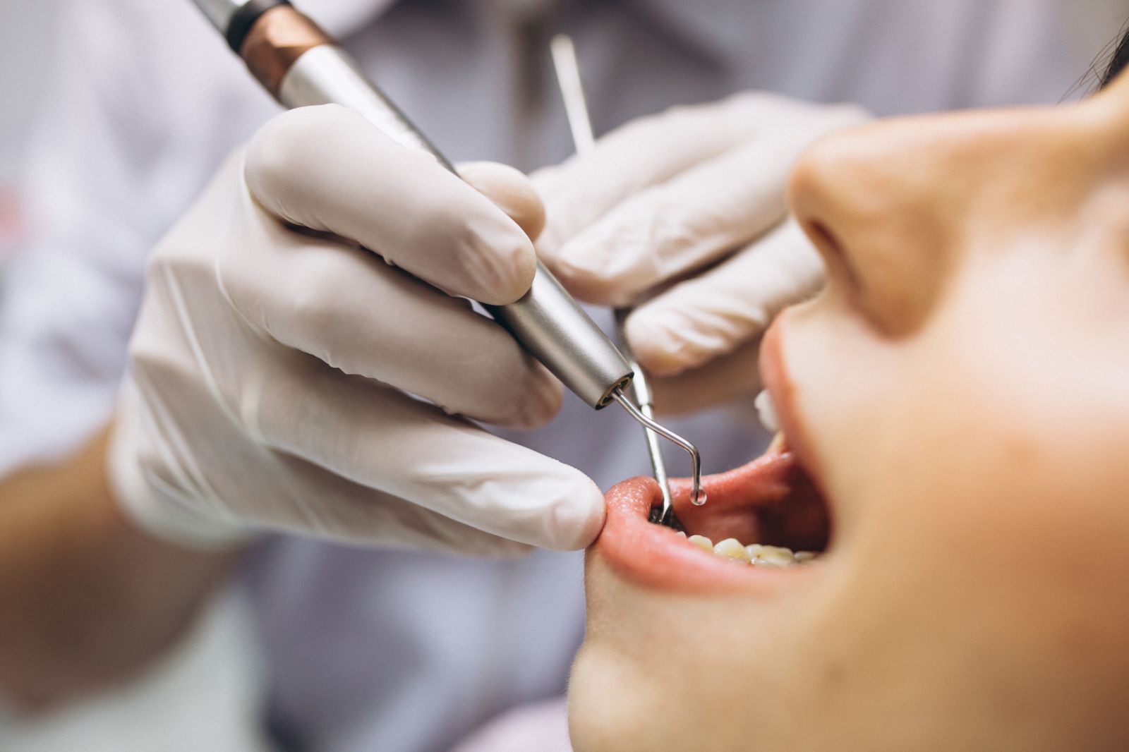 Teeth Scaling and Polishing