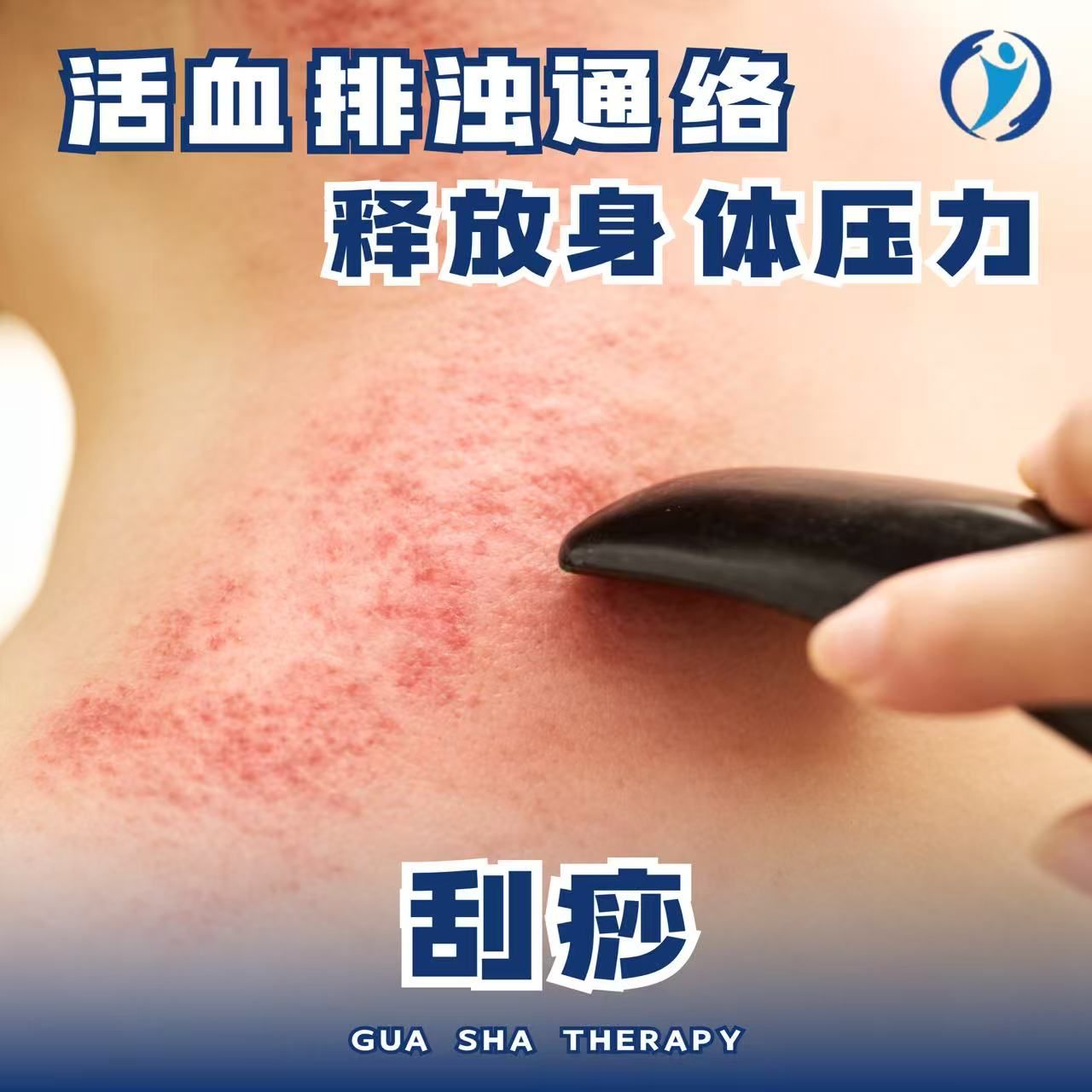 刮痧