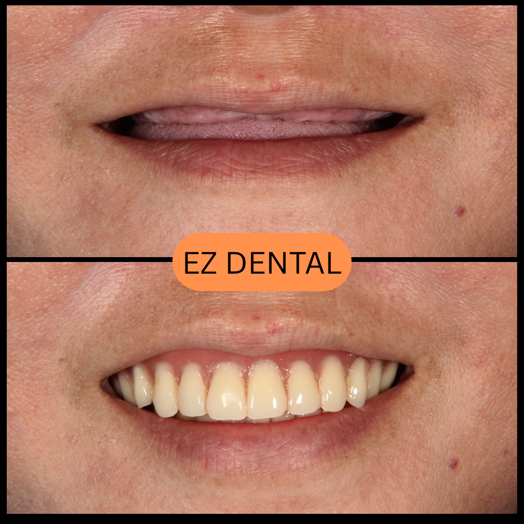 Denture Before & After | EZ Dental Studio Seri Kembangan