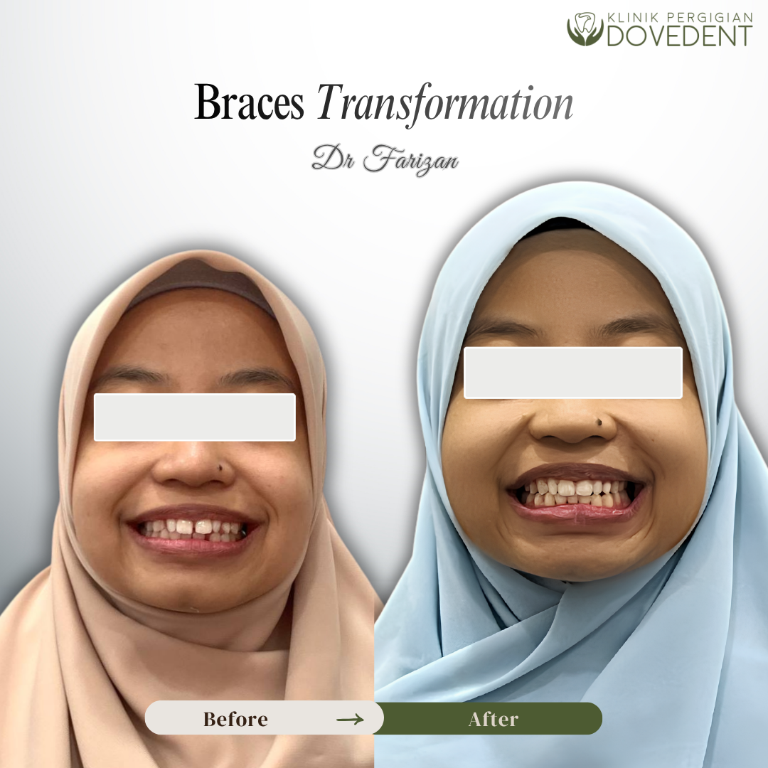 Braces Transformation