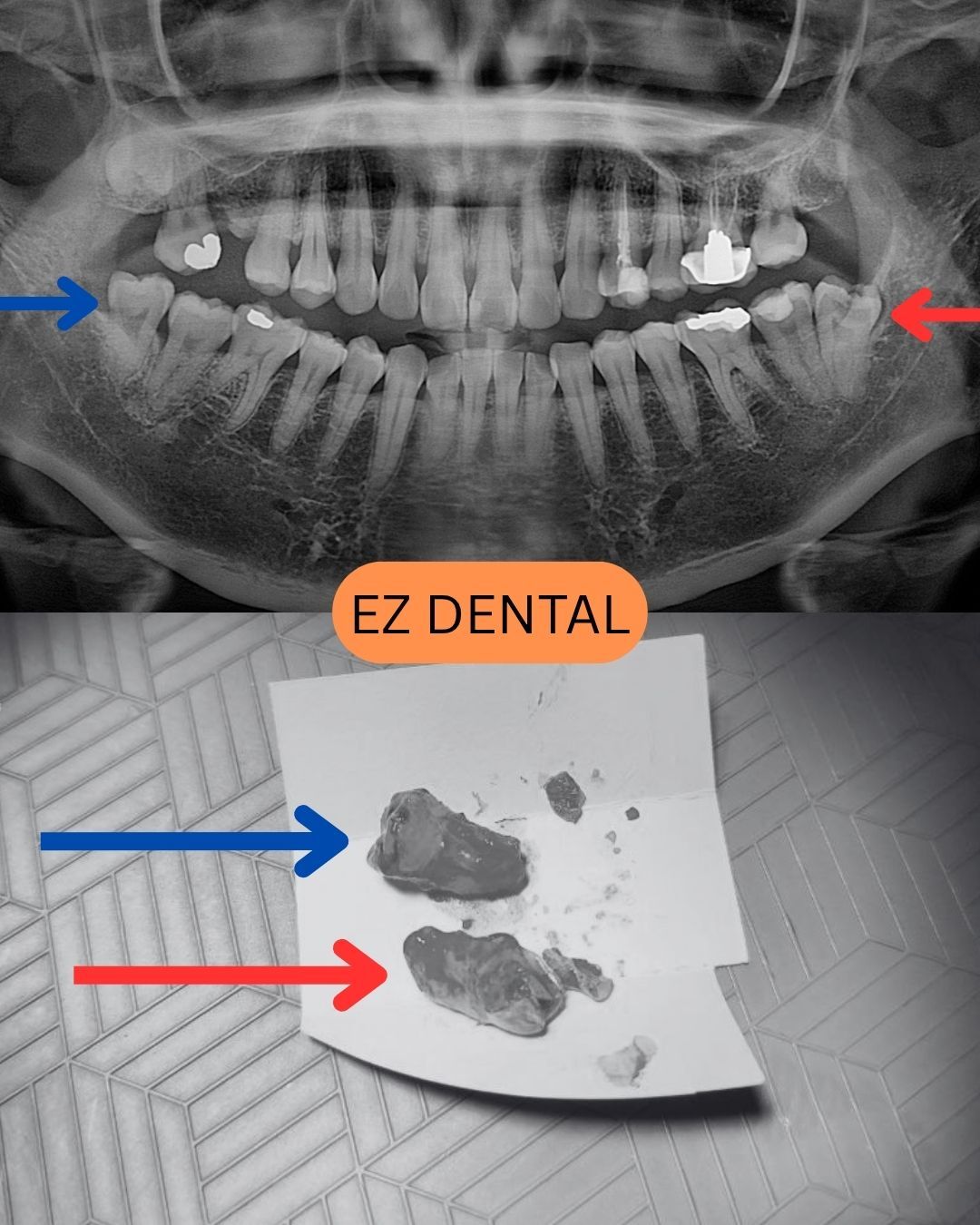 Wisdom Tooth Surgery