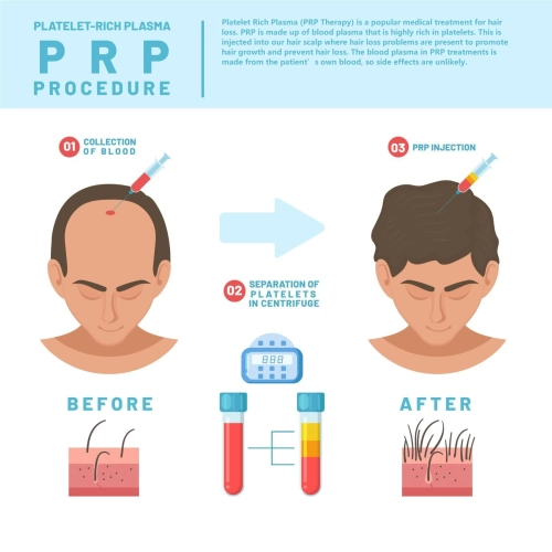 PRP Therapy Hair Loss