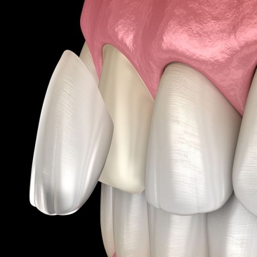 Ceramic Veneer (EMAX)