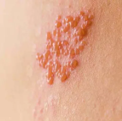 Shingles Treatment