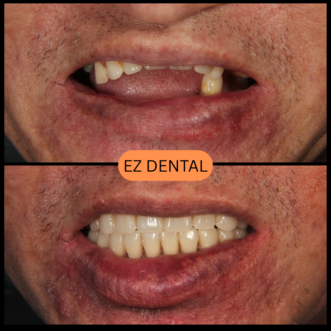 Denture