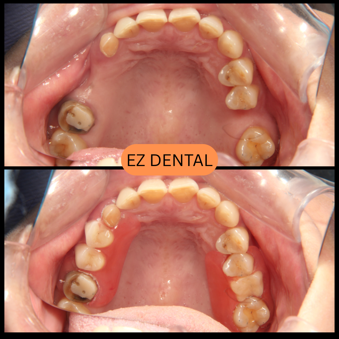 Denture Smile Transformation | Seri Kembangan