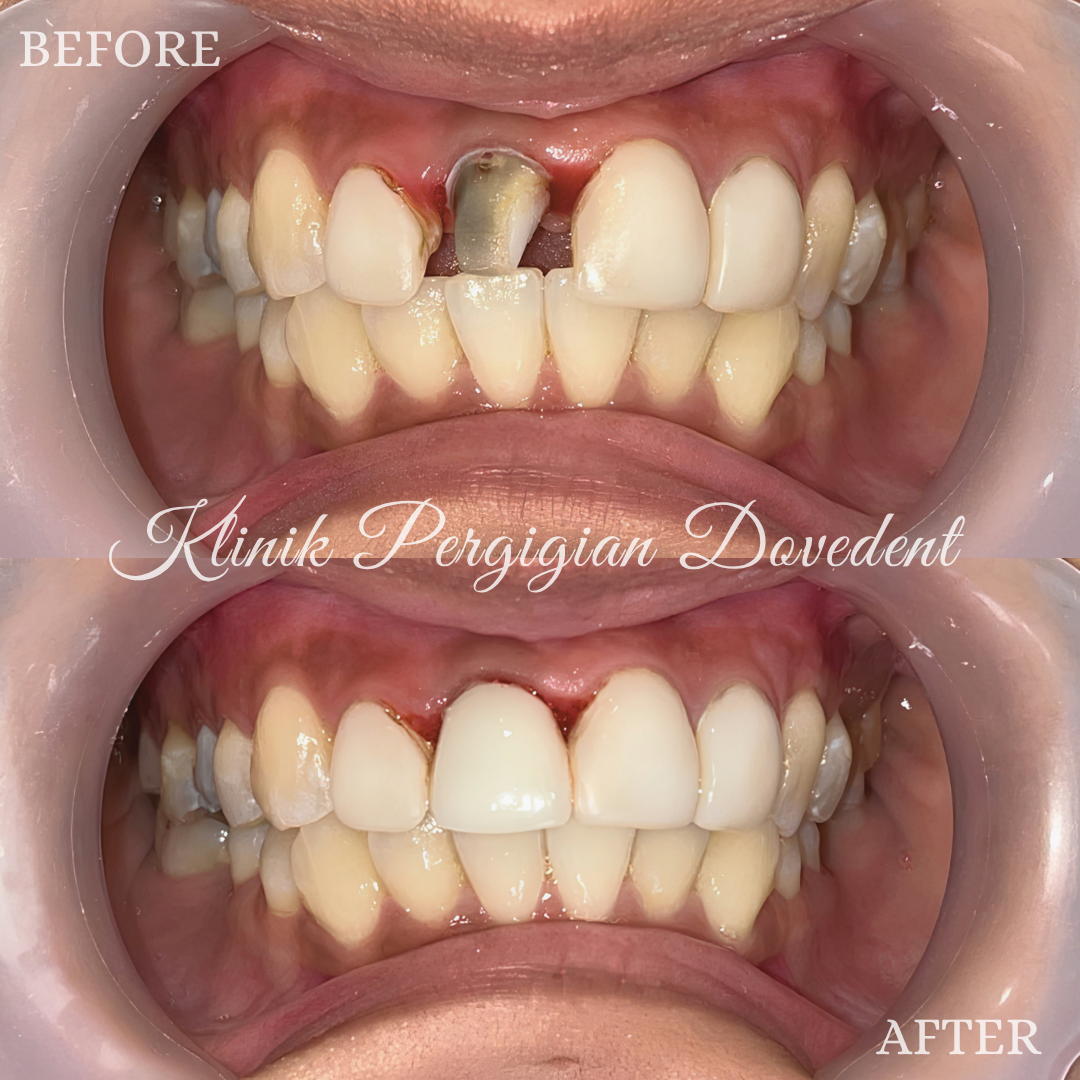 Crown Smile Makeover