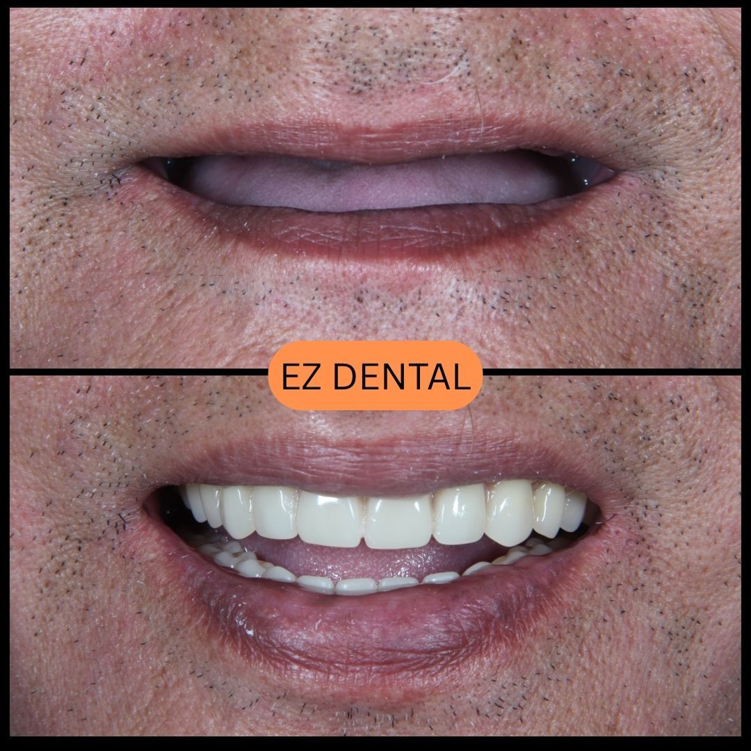 Denture