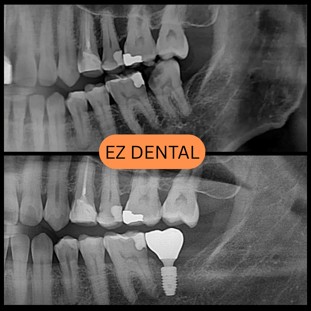 Dental Implant