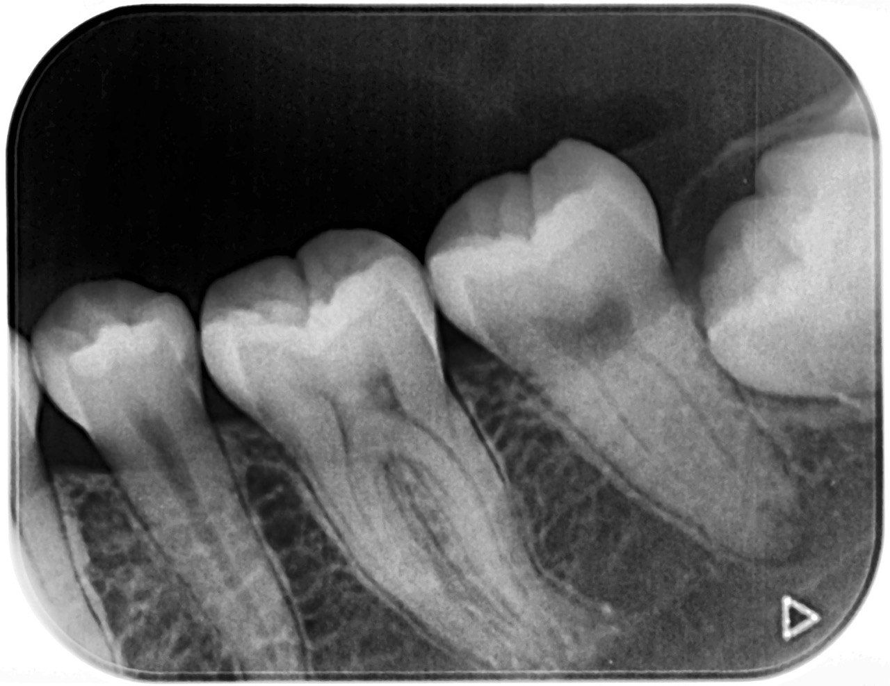 2D Intraoral X-Ray